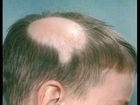 ❂❂Alopecia Areata Hair Regrowth, Laser Hair Regrowth, Hair Regrowth Shampoo For Men
