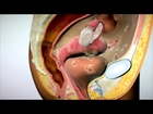 Endometriosis - Video for consumer.mov