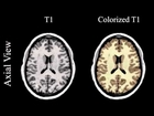 SPGR - Axial View - Comparison of UnColorized vs Colorized MRI scan