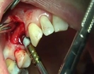 Dr Rodney Aziz - Dental Implantation- Dr Rodney Aziz