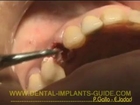 Dr Rodney Aziz - Dental Implant surgery - Immediate Loading